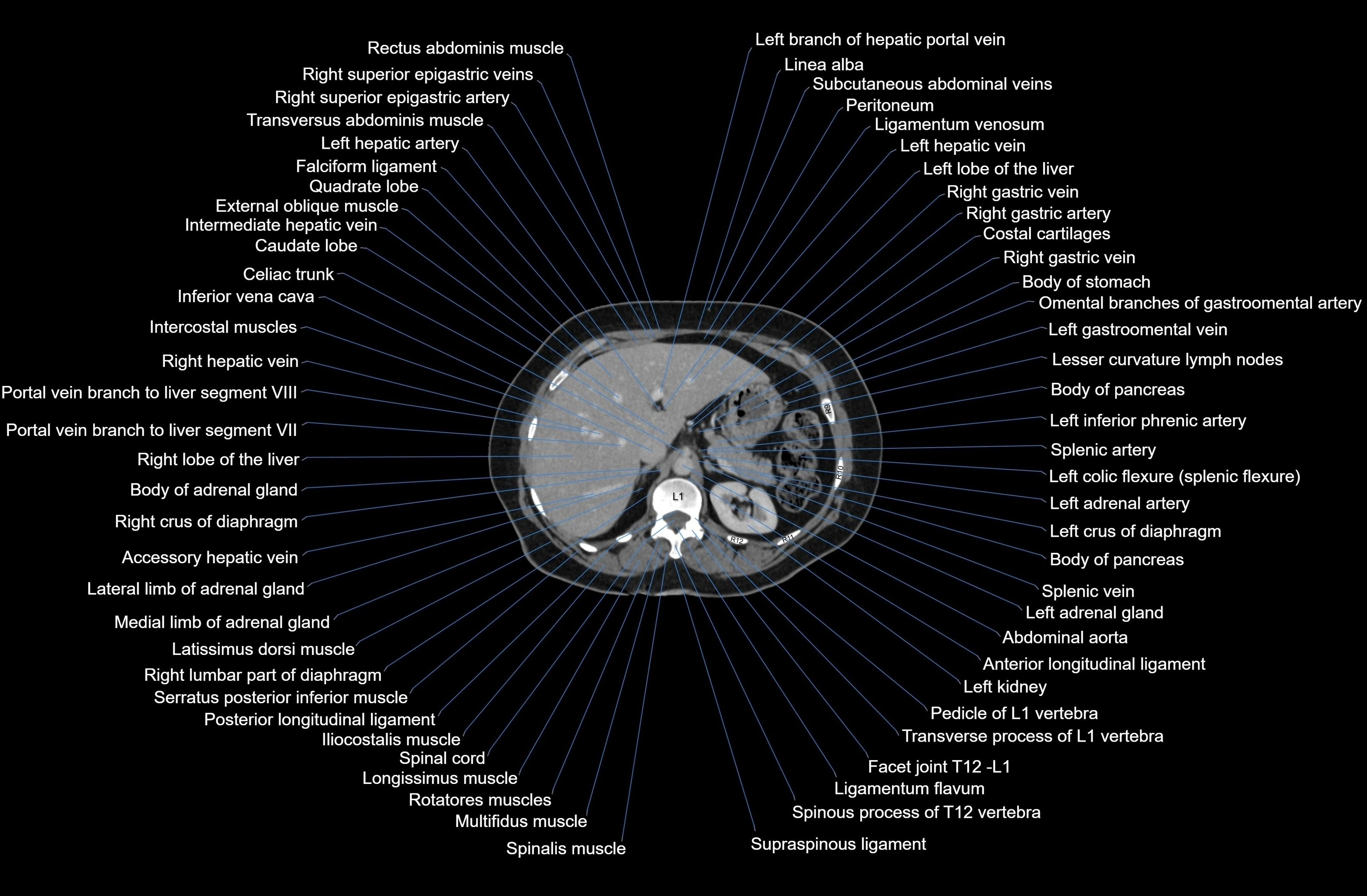 CT Abdomen axial cross sectional anatomy labelled radiology image-00023.webp